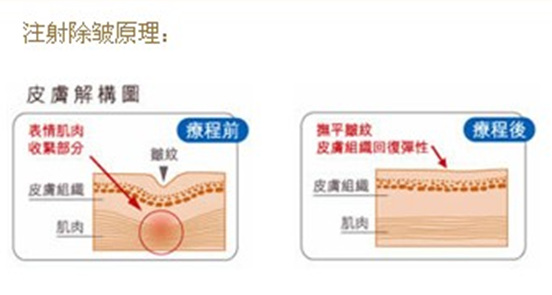注射除皱