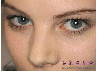 石家庄做双眼皮哪种方法好